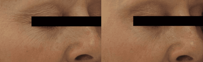 Laser Genesis Before & After Photo