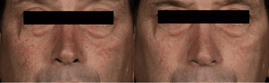 Laser Vein Treatment Before And After Photo
