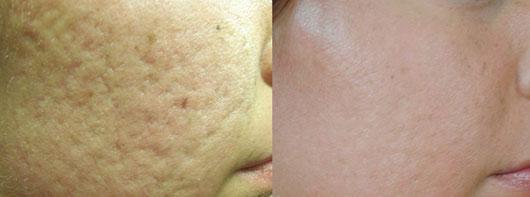 Pearl Fractional Laser Before & After Photo
