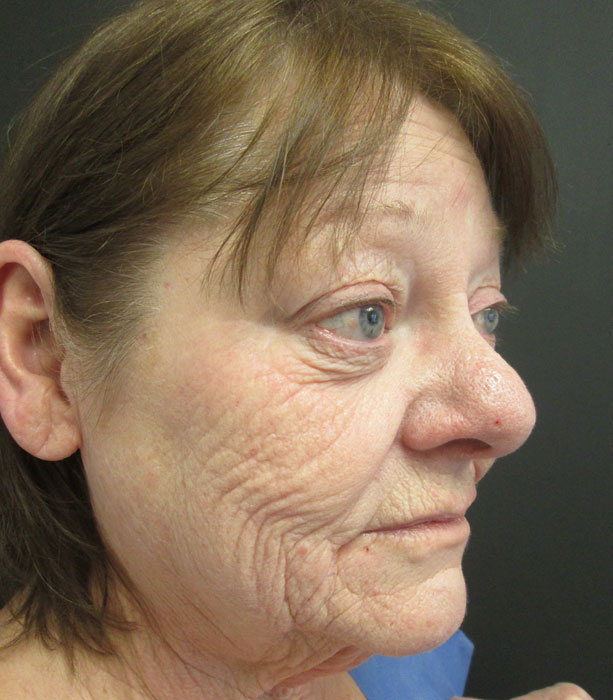 Mak Lift Face Lift Before & After Image