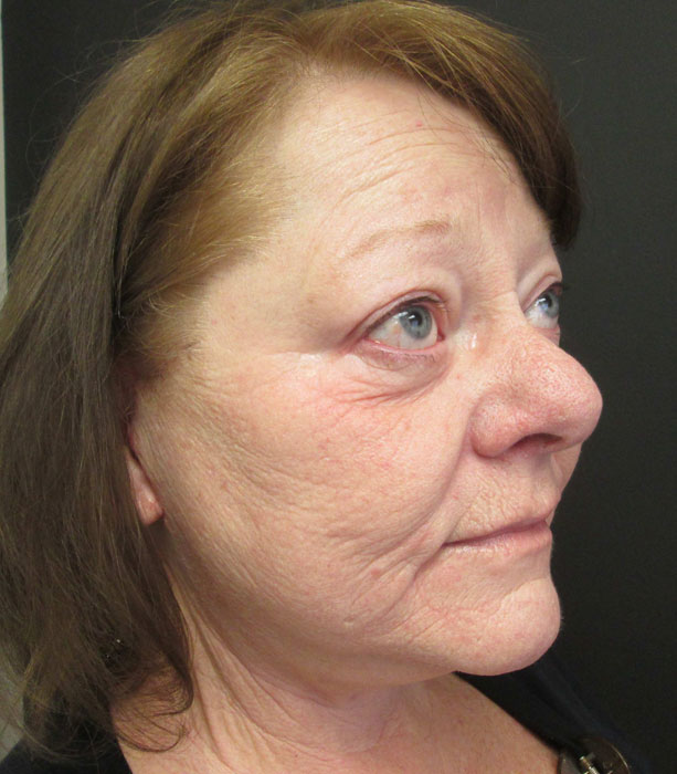 Mak Lift Face Lift Before & After Image