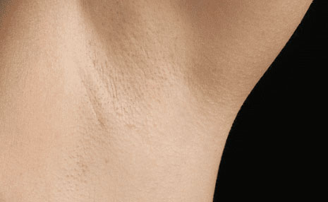 Laser Hair Removal Before & After Image