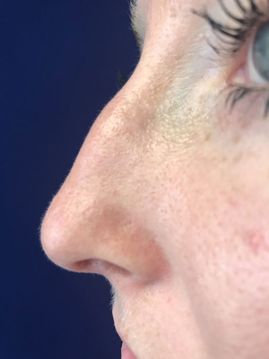 Non-surgical Rhinoplasty Before & After Image