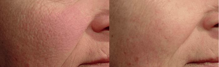 Laser Genesis Before & After Photo