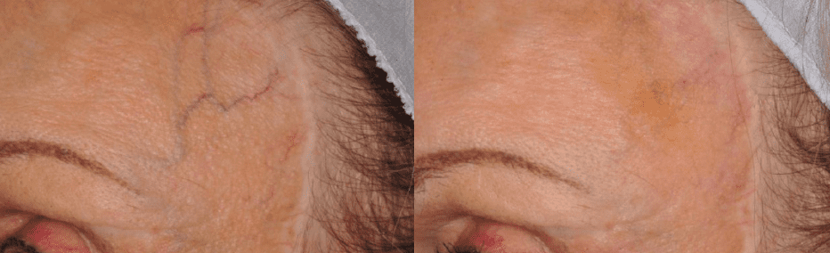 Laser Vein Treatment Before And After Photo