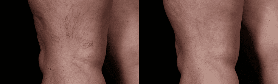 Laser Vein Treatment Before And After Photo