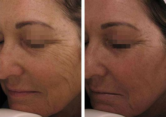 Pearl Fractional Laser Before & After Photo