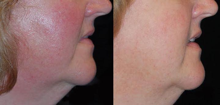 Laser Genesis Before & After Photo