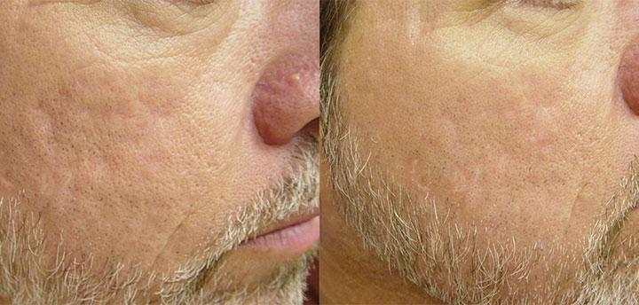 Laser Genesis Before & After Photo