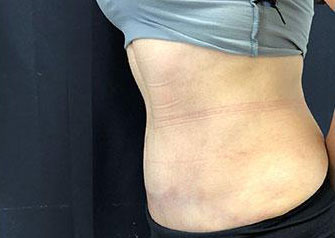 Tummy Tuck Before & After Photos of Patient at The Center for