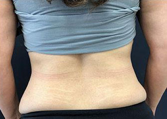 Tummy Tuck Before & After Image