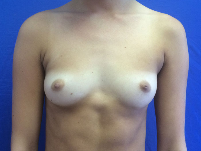 Breast Augmentation Before & After Image