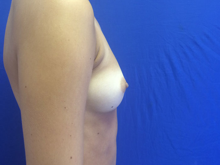 Breast Augmentation Before & After Image