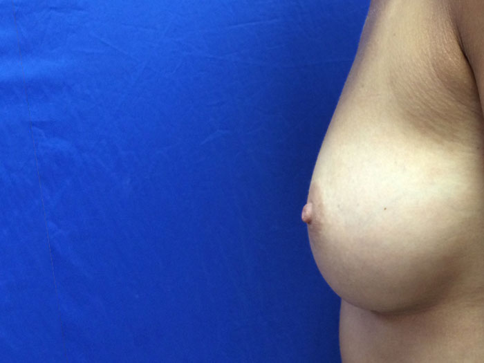 Breast Augmentation Before & After Image