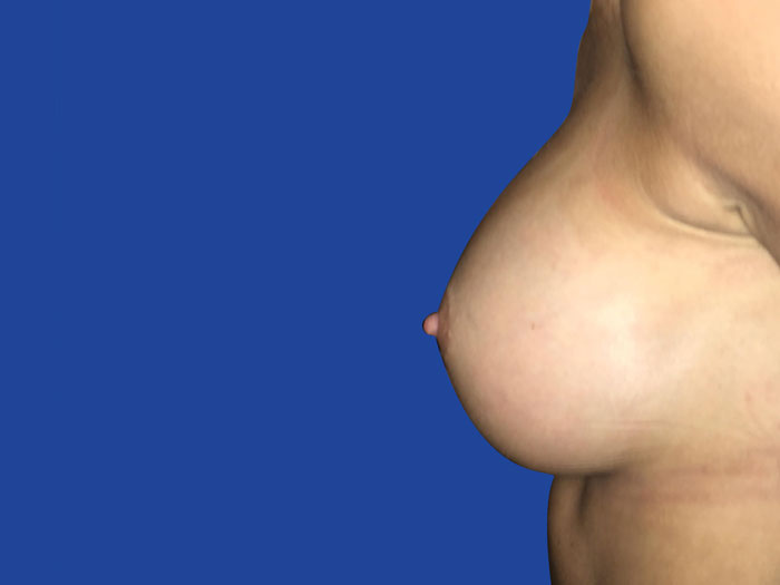 Breast Augmentation Before & After Image