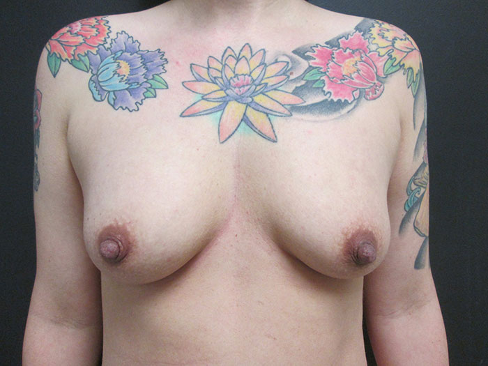 Breast Augmentation Before & After Image