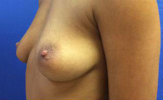 Breast Augmentation Before & After Image