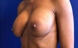 Breast Augmentation Before & After Image