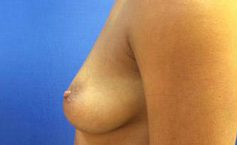 Breast Augmentation Before & After Image