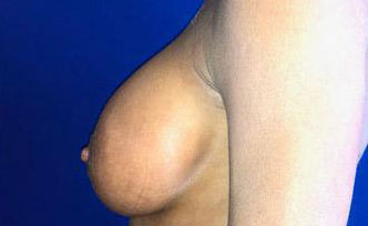 Breast Augmentation Before & After Image