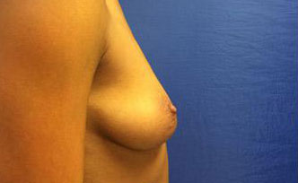 Breast Augmentation Before & After Image