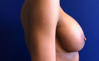 Breast Augmentation Before & After Image