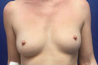 Breast Augmentation Before & After Image