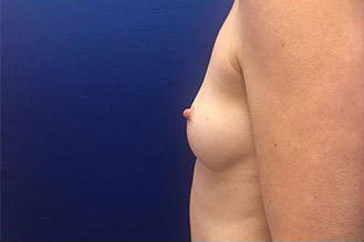 Breast Augmentation Before & After Image