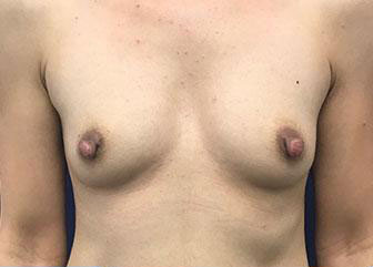 Breast Augmentation Before & After Image