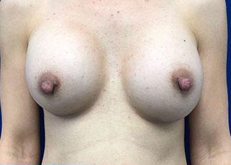 Breast Augmentation Before & After Image