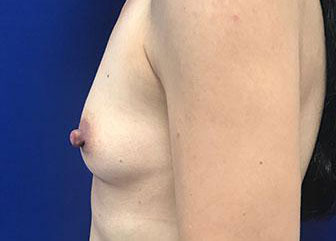 Breast Augmentation Before & After Image