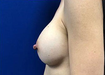 Breast Augmentation Before & After Image