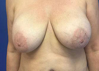 Breast Lift Before & After Image