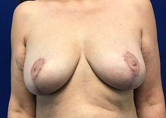 Breast Lift Before & After Image