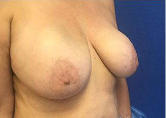 Breast Lift Before & After Image