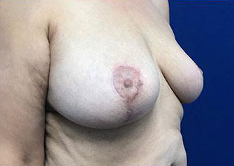 Breast Lift Before & After Image