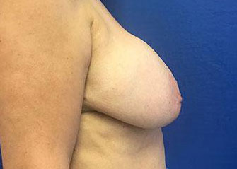 Breast Lift Before & After Image