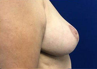 Breast Lift Before & After Image