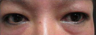 Asian Blepharoplasty Before & After Image