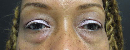 Blepharoplasty Before & After Image