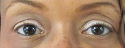 Blepharoplasty Before & After Image