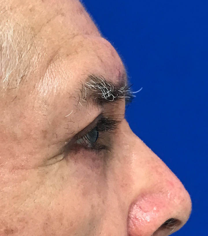 Blepharoplasty Before & After Image