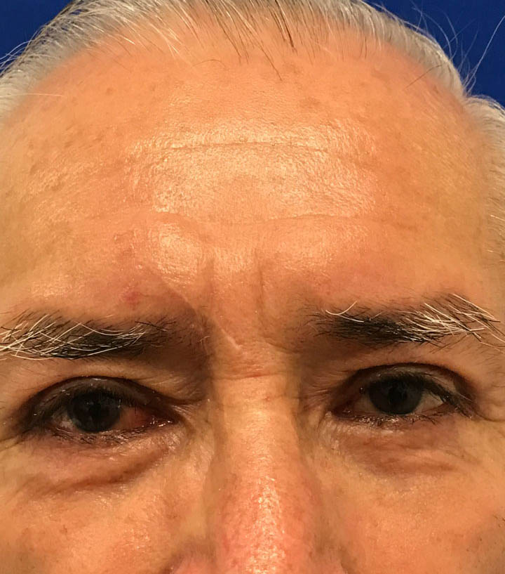 Blepharoplasty Before & After Image