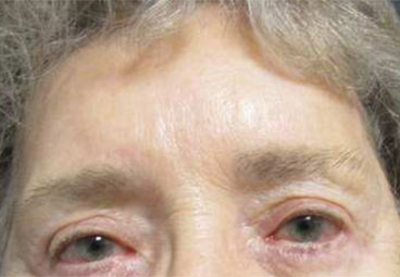 Blepharoplasty Before & After Image