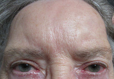 Blepharoplasty Before & After Image