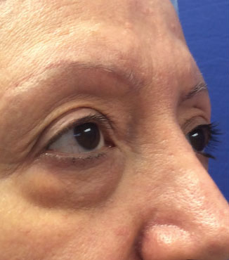 Blepharoplasty Before & After Image