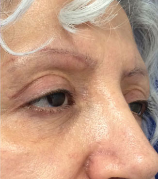 Blepharoplasty Before & After Image