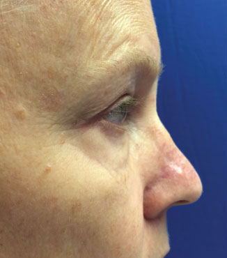 Blepharoplasty Before & After Image