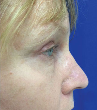 Blepharoplasty Before & After Image