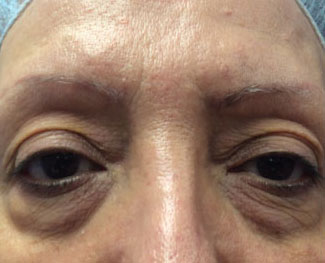 Blepharoplasty Before & After Image